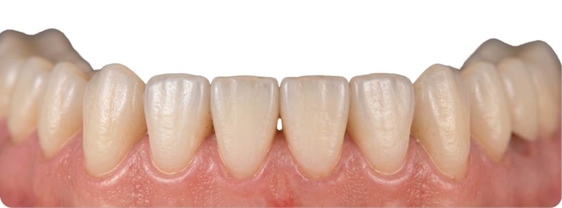 Prótesis dental