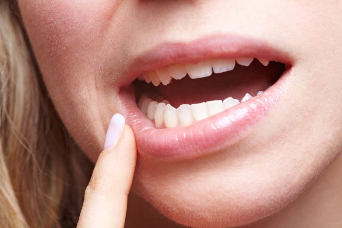 Gingivitis: síntomas, causas y cómo evitar problemas mayores